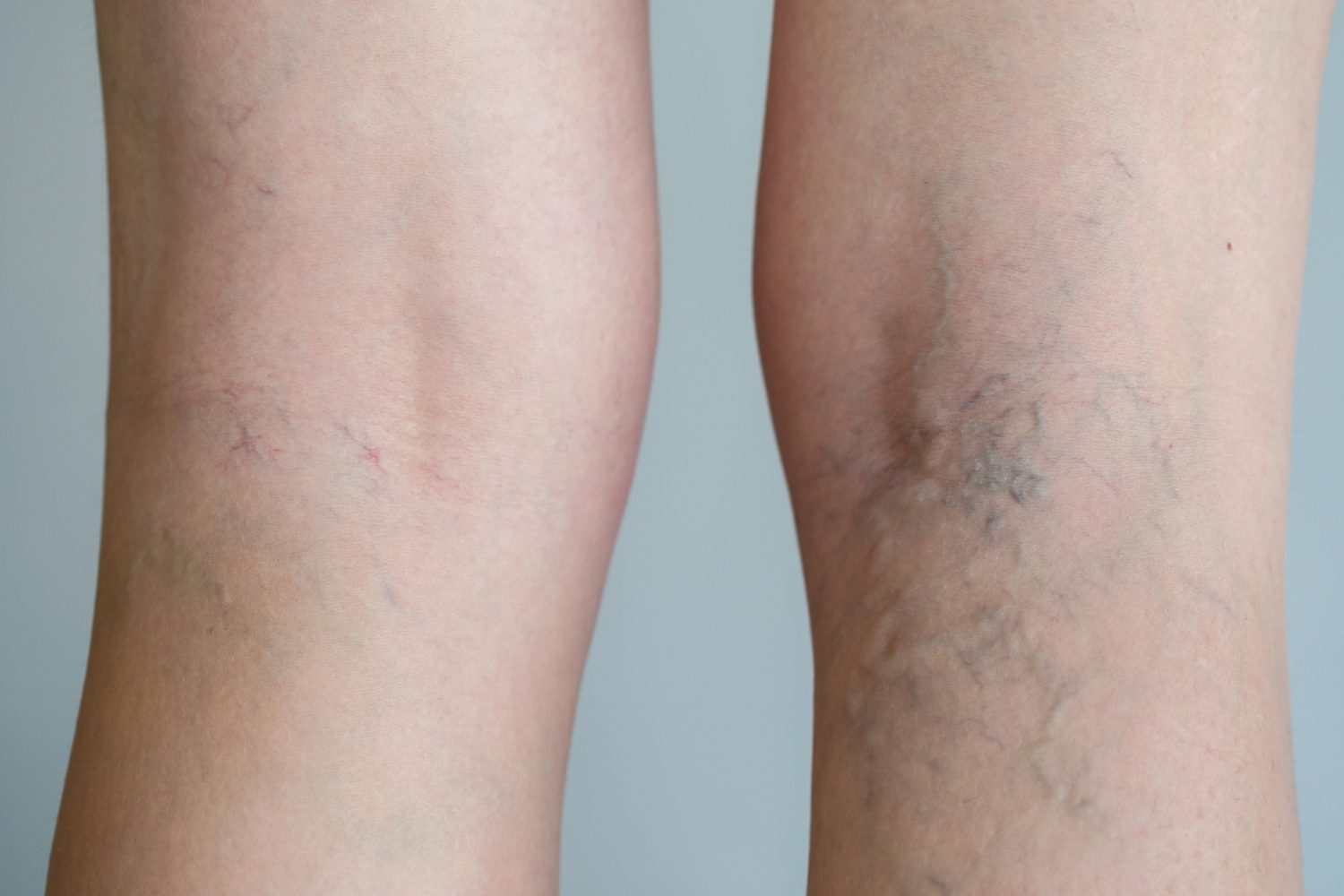 Varicose vein NYMVC Varicose vein NYMVC
